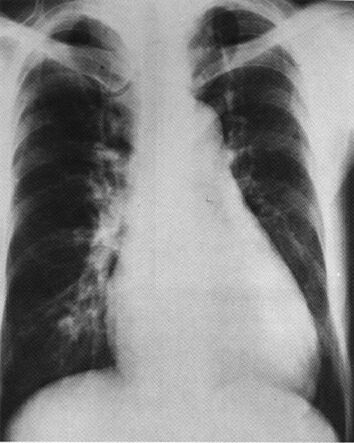 Pda_cxr.jpg (97822 bytes)