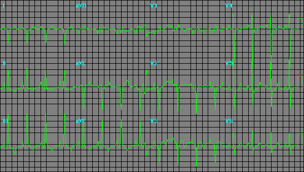 ecg8.gif (14243 bytes)