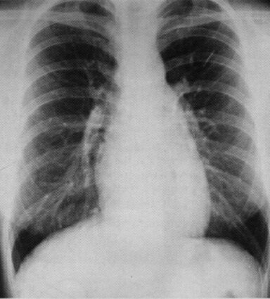 Vsd_cxr.jpg (104652 bytes)