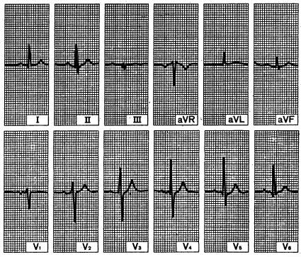 pda_ecg.jpg (71224 bytes)