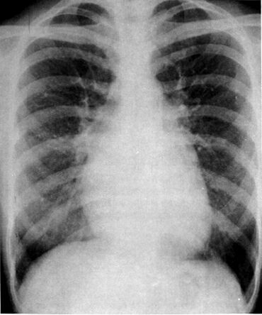 Ms_cxr.jpg (99194 bytes)