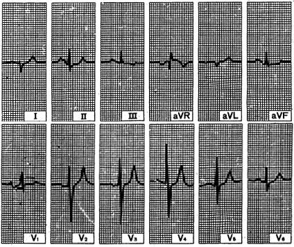 msn_ecg.jpg (62440 bytes)