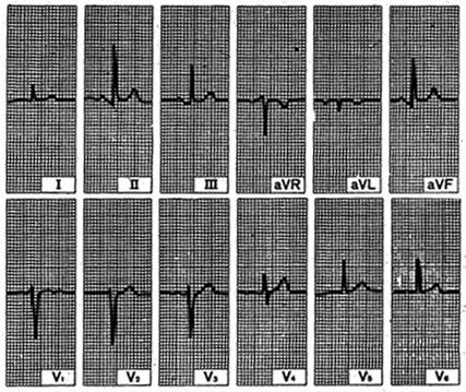 mvp_ecg.jpg (53191 bytes)