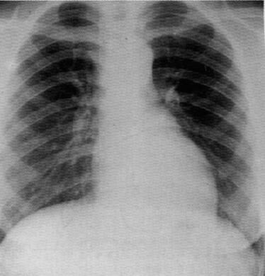 as_cxr.jpg (21481 bytes)