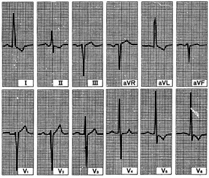 as_ecg.jpg (57156 bytes)