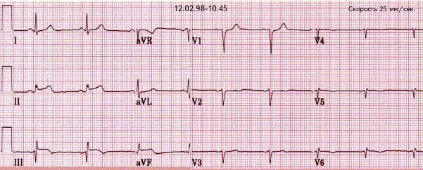 infarct1.jpg (119853 bytes)
